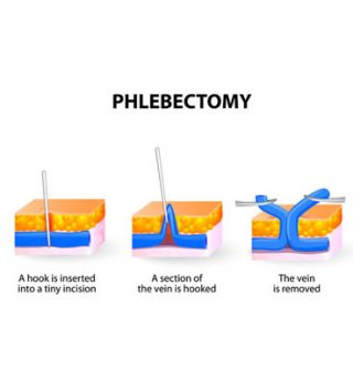 Phlebectomy