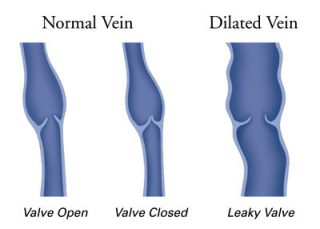 normal vein vs dilated vein