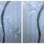 Endovenous(2)