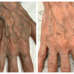 endovenous(1)